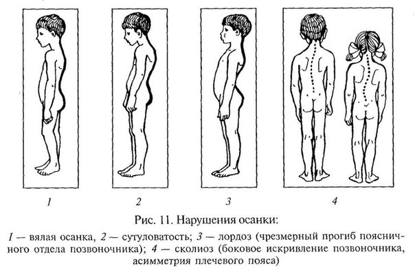 Как избавиться от привычки сутулиться