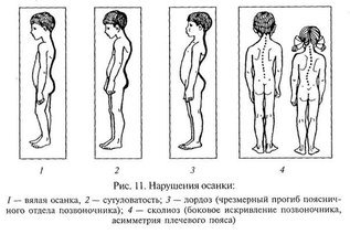 Как избавиться от привычки сутулиться