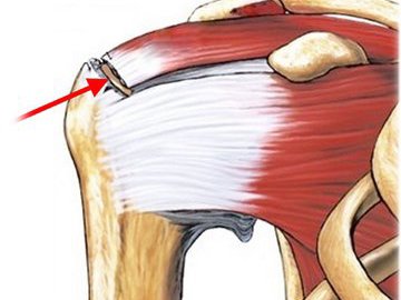 Разрыв ротаторной манжеты плеча: профилактика, клиническая картина, лечение и прогноз