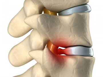 Грыжа межпозвоночного диска